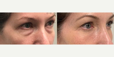 50 year old woman treated with Eyelid Surgery - 50 year old woman complained of under eye bags and dark circles. She underwent a transconjunctival lower lid blepharoplasty with C02 laser resurfacing of skin and lower lids.