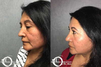 55-64 year old woman treated with Eyelid Surgery - Blepharoplasty (eye surgery) reduced puffiness under the eye