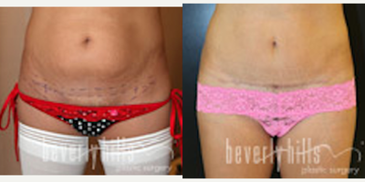 Mini Tummy Tuck - Mini&nbsp;Abdominoplasty and Liposuction of the Abdomen, Hips and Flanks