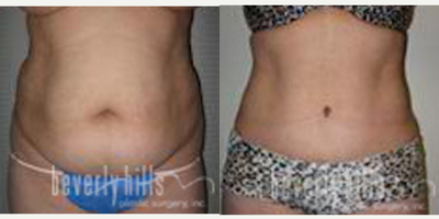 Tummy Tuck - 43 year-old female who wanted a flatter stomach, had a tummy tuck with liposuction of hips and flanks. Approximately 3 liters was liposuctioned, 10 inches of vertical skin removed, and muscles tightened 3 inches. After photo was taken 6 months post-surgery.