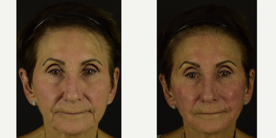 NovaLift with PDO Threads for Non-Surgical Rejuvenation - Demonstrating results with the dissolvable polydioxanone (PDO) threads for the midface and lower third. Notice the very subtle lifting to the cheeks, and significant improvement to the patients smile lines and corners of the mouth. Over time, the PDO threads are reabsorbed within the patients facial tissues, stimulating collagen production. Results typically last anywhere inbetween 9-12 months.