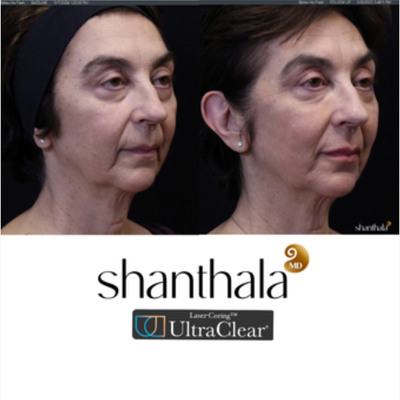 Patient treated with UltraClear Laser - Patient treated with UltraClear Laser