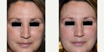 Woman treated with PicoSure - Woman treated with PicoSure