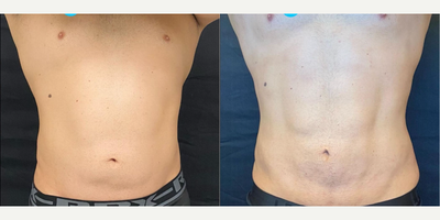 Man treated with A.T.L.A.S. Procedure and Renuvion Skin Tightening - Man treated with A.T.L.A.S. (A-natomicallyT-rueL-ipoA-piratory S-culpting) Procedure and Renuvion skin tightening.This procedure is designed to help patients who work hard to develop their musculature but due to various reasons they cannot reduce the fat in difficult or trouble areas. In the procedure, we define the muscles using liposuction techniques to help define each patients incredible musculature. This is a total body definition procedure where we define all areas (arms, chest, abdomen and back) to provide overall body type appropriate harmony. This patient underwent the procedure but due to concern with his loose skin we also performed the renuvion skin tightening procedure which uses plasma energy and radio frequency to help tighten the skin. Here we see his results at 2 months!