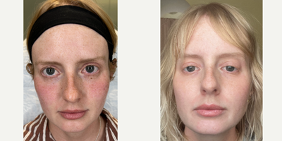AS SEEN IN BUSTLE - Our patient was getting tired of looking tired from the dark circles beneath her eyes. She's a high profile model and must look her best for magazine shoots. So, we treated her with one of our favorite devices-the Plasma Pen! By creating compact dots upon the surface of the skin, it tightened and brightened her eye area giving her that lively appearance she was afterBook your consultation today by clicking the link in our bio! 