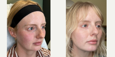 AS SEEN IN BUSTLE - Our patient was getting tired of looking tired from the dark circles beneath her eyes. She's a high profile model and must look her best for magazine shoots. So, we treated her with one of our favorite devices-the Plasma Pen! By creating compact dots upon the surface of the skin, it tightened and brightened her eye area giving her that lively appearance she was afterBook your consultation today by clicking the link in our bio! 