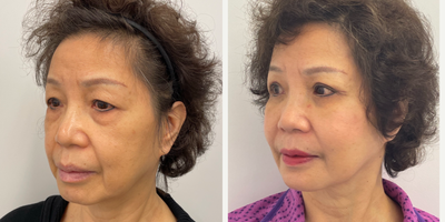 65-74 year old woman treated with Eyelid Surgery, Facial Fat Transfer - My 71 year old patient is 2 weeks out from and Upper and Lower eyelid blepharaoplasty and a facial fat transfer.