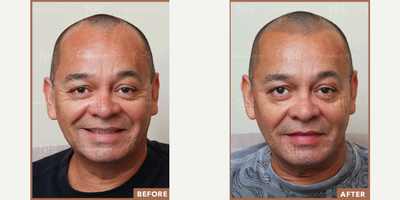 45-54 year old man treated with Scalp Micropigmentation - 45-54 year old man treated with Scalp Micropigmentation