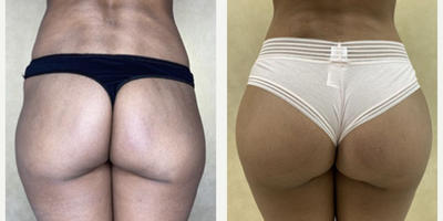 Woman treated with Butt Augmentation - Woman treated with Butt Augmentation using implants