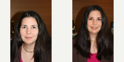 35-44 year old woman treated with Glycolic Peel - Unbuffered Glycolic Acid Peel and Jorgee Makeover
