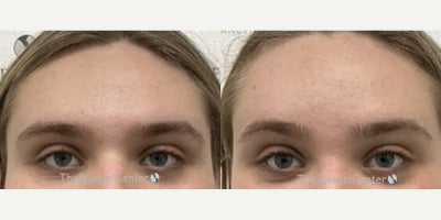 18-24 year old woman treated with Forehead Reduction - 18-24 year old woman treated with Forehead Reduction