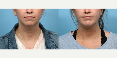 25-34 year old woman treated with Chin Surgery - This 25-year-old patient turned to Dr. Wise with concerns about submental fullness and a weak chin that drew attention away from her other facial features. Six weeks after a combination chin implant and submental liposuction surgery, she is thrilled with her natural results, and especially with no longer having a double chin.