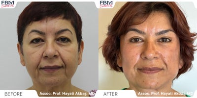 45-54 year old woman treated with Deep Plane Facelift, Canthoplasty - 45-54 year old woman treated with Deep Plane Facelift