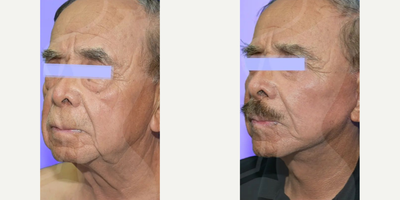 Man treated with Chin Implant, Facelift - Men also want to look and feel better.Procedures: Low Rhytidectomy (Cavity/Jaw/Neck) + Blepharoplasty + Chin Implant