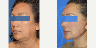 Woman treated with Facelift, Rhinoplasty - Don't waste another year wanting to look like you've always dreamed the best thing about starting a year is that we come recharged with motivation, work for it, and look for your best option and the best is Dr. Eduardo Gngora.Procedures: Complete Rhytidectomy + Rhinoplasty.