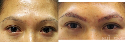 25-34 year old woman treated with Eyebrow Transplant - This is how an eyebrow transplant looks immediately after (before she went home).