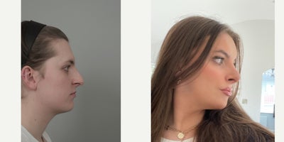 18-24 year old woman treated with Asian Rhinoplasty, Facial Fat Transfer, Nonsurgical Facelift, Rhinoplasty, V Line Surgery - .