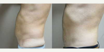 Male Liposuction - Patient wanted contouring of his abdomen and hips after losing weight with diet and exercise.  Dr. Schaffer removed excess fat from the lower abdomen and hips with Liposuction.