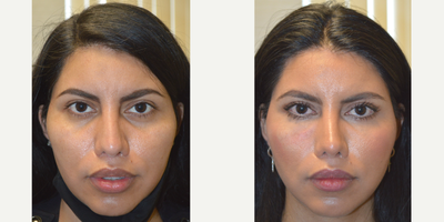 customized infraorbital rim implant in transgender female - Middle aged man, a neurosurgeon with eyelid aging and tired appearing eyes, underwent lower blepharoplasty (transconjunctival technique with eye fat repositioning and skin pinch) and conservative male upper blepharoplasty. Before and 3 months after selfie photos are shown.
