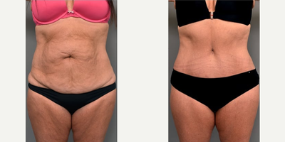 Woman treated with Liposuction - Woman treated with Liposuction