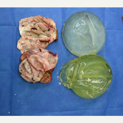 45-54 year old woman treated with Breast Implant Revision, Breast Lift with Implants, Capsular Contracture Treatment - 54 year old female from Hollywood, Florida 5 months after exchange of implants to smaller size with capsulectomies and a breast lift (mastopexy) performed by Dr Sam Gershenbaum. She presented with subglandular 550cc implants, ruptured on the left as well as Baker III capsular contracture and sagging of her breasts. Her breasts were hard and uncomfortable. Full intact capsulectomies were performed with exchange of implants to 330cc placed now under the muscle along with a bilateral breast lift. The photo shows her ruptured implant along with very calcified capsules.  Now, five months later, her breasts are soft, comfortable and a more appropriate size. Her scars are healing excellent and will continue to fade over the months ahead. She is extremely happy with her results.