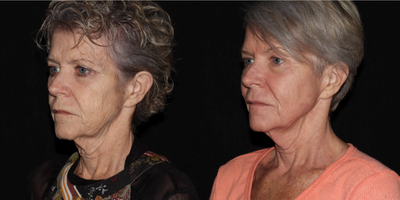 55-64 year old woman treated with SmartSkin, LED Light Therapy - This patient received SmartSkin CO2 Laser Skin Resurfacing, along with TriWave LED light therapy sessions to help speed her healing. This result is still developing as the after images are 12 days post procedure. She will be building additional collagen from this one procedure for 3 months with continued smoothing and tightening expected.