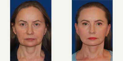 55-64 year old woman treated with Deep Plane Facelift - A female patient had a deep plane face and neck lift, upper blepharoplasty