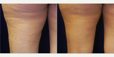 Woman treated with EndyMed 3Deep - Woman treated with EndyMed 3Deep.