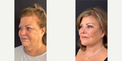 72 year old woman treated with Facelift Revision - 72 year old woman treated with Deep Plane Facelift, Neck Lift, Lateral Brow Lift, and Lip Lift.