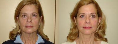 Blepharoplasty & Mini Lift - 	Lower Blepharoplasty & Mini-face lift