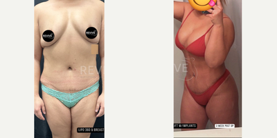 35-44 year old woman treated with Liposuction, Breast Lift with Implants - 35-44 year old woman treated with liposuction 360, to remove fat from her back, sides and stomach and addressed her breasts with a lift and implants.