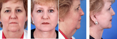 Complete facial plastic surgery, age 56 - 
	Chin Liposuction
