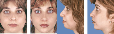 Rhinoplasty with chin implant front view - 
	Chin Implant
