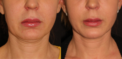 Woman treated with Renuvion - Woman treated with Renuvion