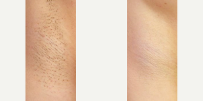 Woman treated with Laser Hair Removal - Woman treated with Laser Hair Removal