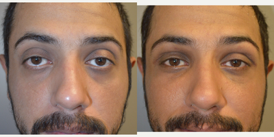 31 year old male, with inherited bulgy frog eyes, had orbital decompression + lid retraction surg. - 31 year old male, who c/o inherited frog eyes with inherited bulging eyes, hollowness and darkness around eyes, and sclera show (lower eyelid retraction). He wanted more almond shape eyes. He cosmetic orbital decompression surgery, lower eyelid retraction surgery (without internal spacer graft), under-eye tear trough implant (to correct under eye hollowness, dark circles), followed later by filler injection in upper eyelids. Preop and 1 month postoperative photos are shown. Note improvement in lower eyelid position with elimination of sclera show and more almond shape eyes with less hollowness and darkness around eyes. (His upper eyelid ptosis was not addressed.)