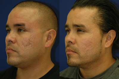 Subcision on a 37 Year Old Hispanic Male for Rolling Acne Scars - 	After photos are 1 year after one subcision treatment for the patient's rolling acne scars. Of note on his Before photos, this patient already had 1 full CO2 laser resurfacing ($8000) and a series of Fraxel Restore sessions ($6000 total). This patient did feel that the texture and color improved with the lasers, but did nothing pop out the acne scars after the multiple laser treatments. The single subcision session popped out the indented rolling scars more than the combined efforts of multiple laser session including a full CO2 laser resurfacing. Although his skin is not perfect after a single session, the improvement surpassed the promises of his prior laser sessions. This patient had a second subcision session at his 1 year follow up.