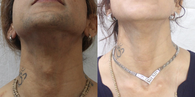 18-24 year old man treated with Adam's Apple Reduction - 24 Years old M2F Trans Operated for Adam's Apple Reduction surgery by Dr Narendra Kaushik