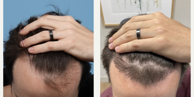 22 year old man treated with Hair Transplant - Follicular Unit Extraction Hair Transplant