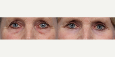 55-64 year old woman treated with Eyelid Surgery, CO2 Laser - Lower Eyelid Surgery with Co2 Laser