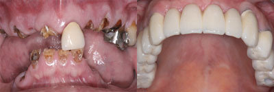 Dental Implants - 
	PT had not been to dentist in several years and neglected her teeth. They could not be resored becasue they were broken at teh gumline. Pt wanted to address her top jaw first. All teeth were removed, the bone was smoothed and dental implants were placed at the same time. A temporary bridge was placed on the implants the day of surgery which will be replaced by a permanent bridge in about 4 months
