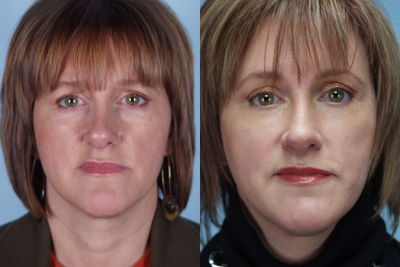 Lower Eyelid Hetter Peel - 
	This patient had a Lower eyelid Resurfacing with an Endoscopic Brow lift and Upper &amp; Lower Eyelid Surgery.
