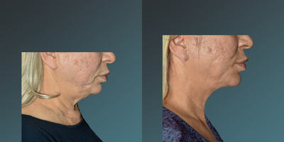 35-44 year old woman treated with Thermage FLX - 35-44 year old woman treated with Thermage FLX