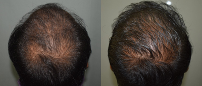 25-34 year old man treated with Derma Roller - 30 years old male complaints of hair thinning since 2 years. Derma roller procedure done for the scalp.