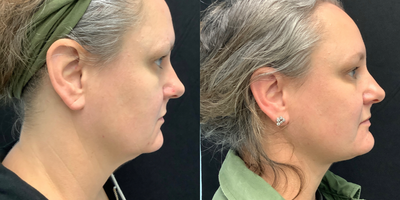 18-24 year old woman treated with Chin Liposuction - CHEEKAGO!