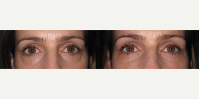35-44 year old woman treated with Dermal Fillers - Filler to tear troughs.