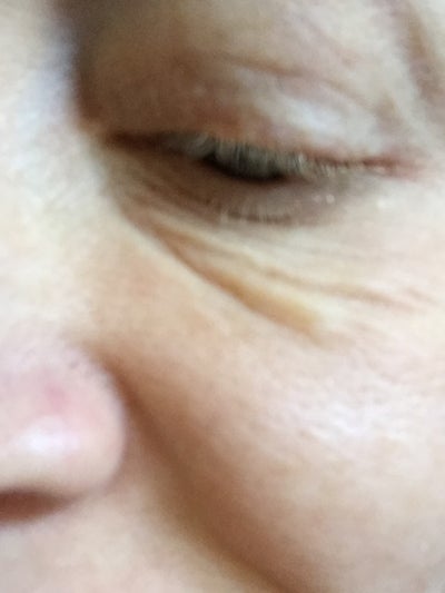 I need to fix my under eye problem. Do at home lasers work