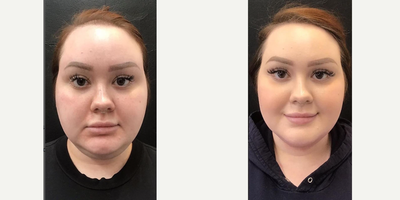 Woman treated with BodyFX - MiniFX is the smaller version of our BodyFX! Designed for smaller areas of the face and body, it is a noninvasive shaping and cellulite treatment. Perfect for the neck, knees, arms, back, etc. 