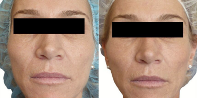 Venus Viva - Before and After 3 Treatments. Photos provided courtesy of Venus Concept, performed by Gregory P. Antoniak, MD.