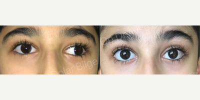 17 or under year old man treated with Strabismus Surgery - Strabismus in children should be treated at an early age due to various problems such as amblyopia, loss of depth of vision and cosmetic problems. Treatment options vary from patient to patient.
